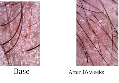 Follicle close-up, base versus after 16 weeks