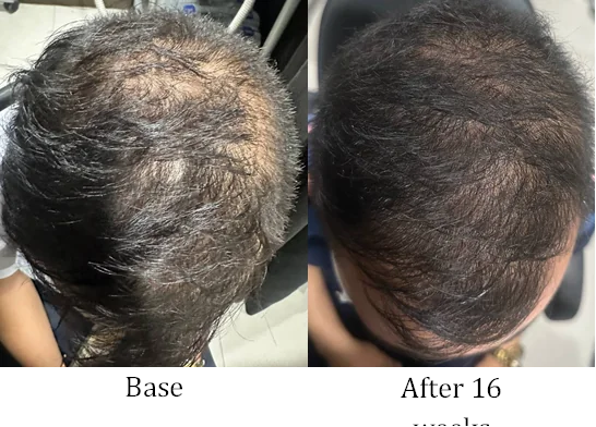 Scalp density, base versus after 16 weeks